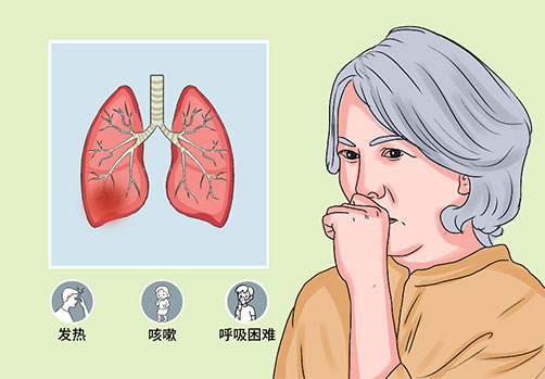 顽固性咳嗽的中医治疗策略——郭亚雄医生为您支招