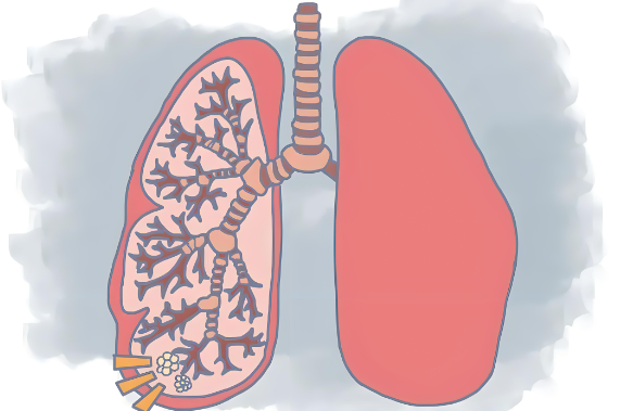 肺结节有什么症状和不适